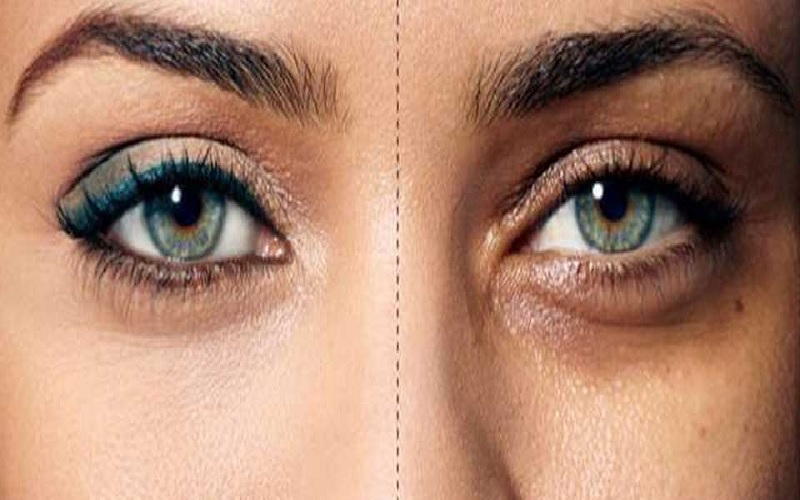 پف و تیرگی زیر چشم: راهنمای جامع تشخیص، علت و درمان 2 علل شایع پف و تیرگی زیر چشم: چرا دچار آن میشویم؟