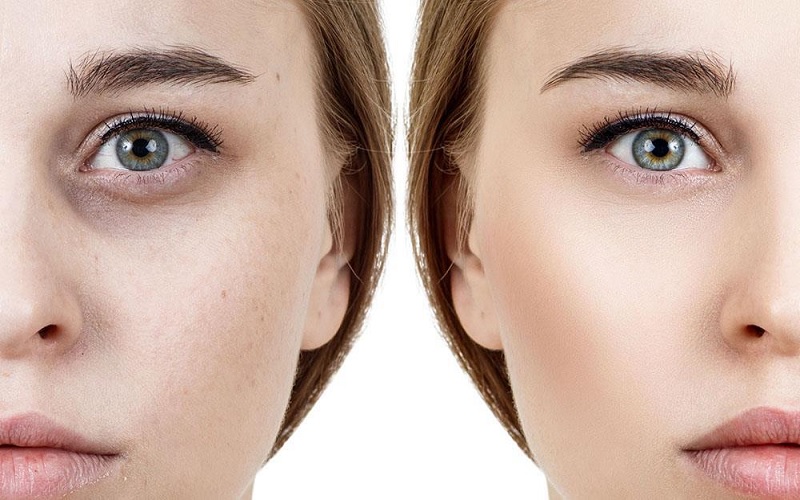 پف و تیرگی زیر چشم: راهنمای جامع تشخیص، علت و درمان 4 پیشگیری از پف و تیرگی زیر چشم: راهکارهای موثر