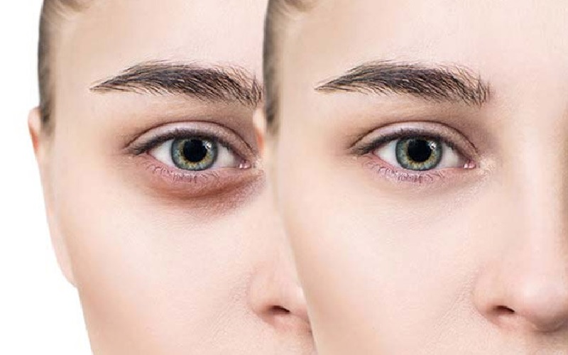 پف و تیرگی زیر چشم: راهنمای جامع تشخیص، علت و درمان 5 گزینههای درمانی پزشکی و زیبایی برای پف و تیرگی زیر چشم