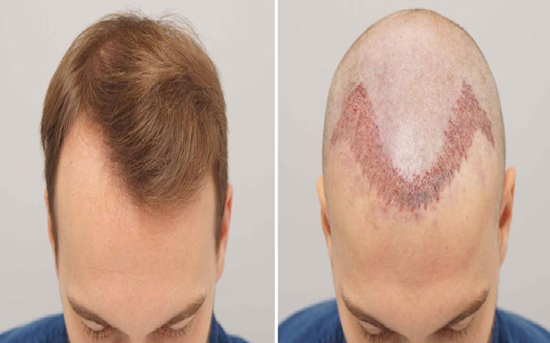 کاشت مو با الیاف نانو چیست و چگونه انجام میگیرد؟ 3 روند انجام کاشت مو با الیاف نانو