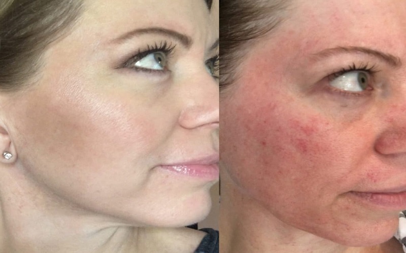 راهنمای کامل درماپلنینگ: مزایا، مراحل انجام و مراقبتهای بعد از آن 3 مراحل انجام درماپلنینگ