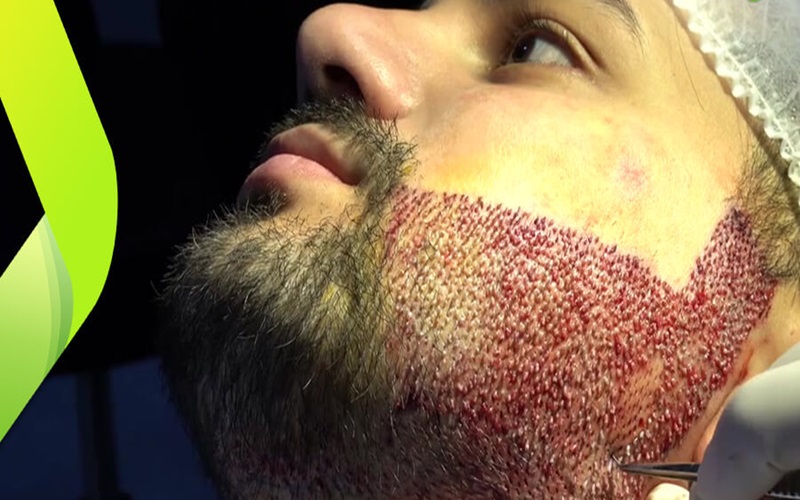 سوالات رایج در خصوص کاشت ریش: راهنمای کامل برای آقایان 1 پ