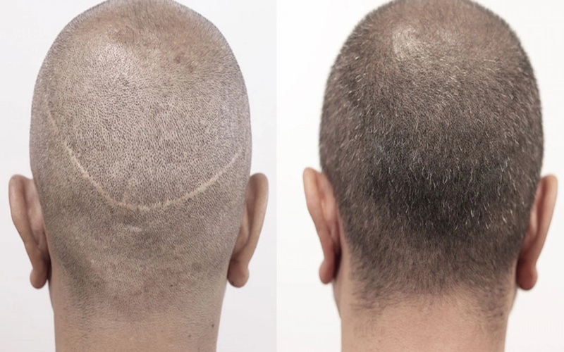 ممنوعیات پس از کاشت مو: نکات حیاتی برای بهبودی سریع و نتیجه طبیعی 1 همیت رعایت ممنوعیات پس از کاشت مو