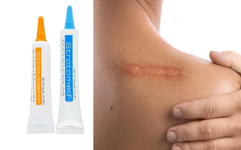 پماد برای از بین بردن جای زخم؛ معرفی بهترین کرمها و ژلهای ترمیمکننده 2 پماد استراتادرم (Strataderm)؛ راه حل جای زخمهای قدیمی و اسکار