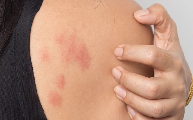 چرا کهیر میزنیم؟ درمان کهیر پوستی چیست؟ 4 مشاوره با متخصص پوست یا آلرژی