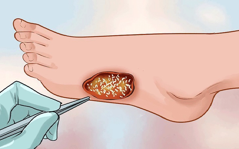 دبریدمان زخم چیست؟ آیا دردناک است؟ | راهنمای کامل انواع و روشها 1 دبریدمان زخم چیست و چرا اهمیت دارد؟