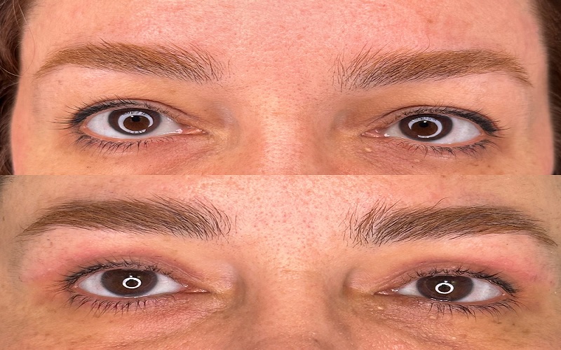 بهترین سن برای عمل بلفاروپلاستی چه سنی است؟ 1 بهترین سن برای بلفاروپلاستی