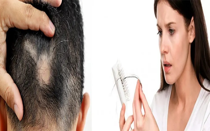 استرس و ریزش مو؛ آیا استرس میتواند باعث ریزش مو شود؟ 1 ارتباط بین استرس و ریزش مو