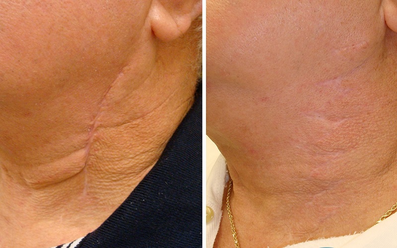 اسکار جراحی: هرآنچه باید درباره جای زخم عمل و درمان آن بدانید! 1 اسکار جراحی چیست و چرا ایجاد میشود؟