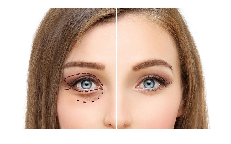 بهترین سن برای عمل بلفاروپلاستی چه سنی است؟ 2 کاندیداهای مناسب عمل بلفاروپلاستی