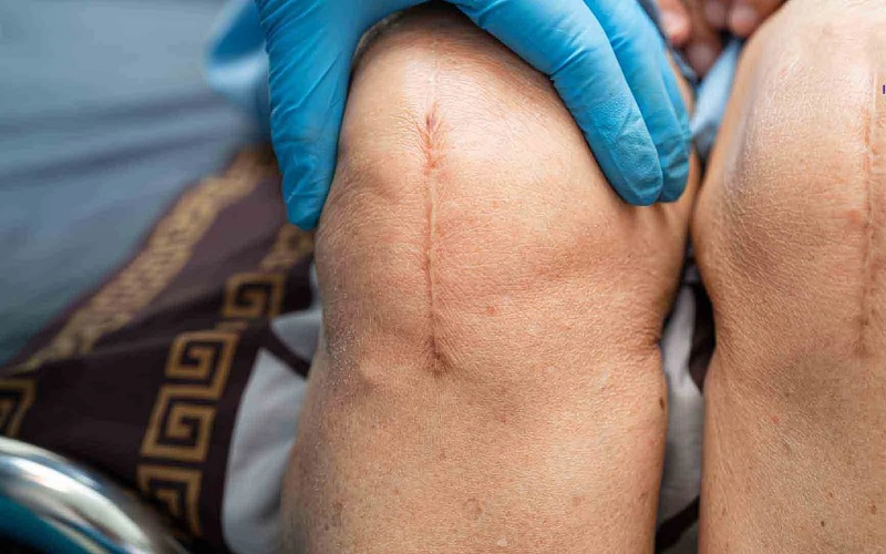 اسکار جراحی: هرآنچه باید درباره جای زخم عمل و درمان آن بدانید! 2 عوامل افزایش دهنده خطر تشکیل اسکار جراحی