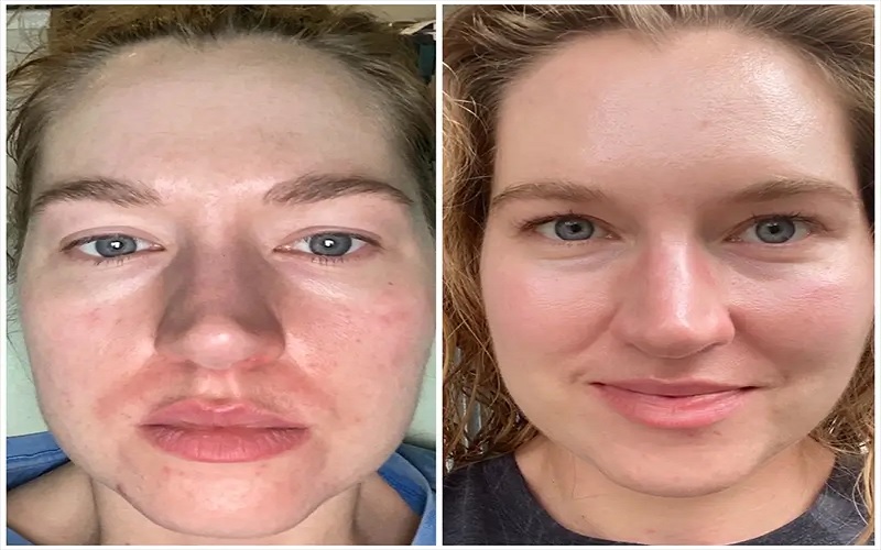 رتینول چیست و چه خواصی برای پوست دارد؟ 2 خواص رتینول برای پوست