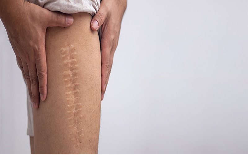 اسکار جراحی: هرآنچه باید درباره جای زخم عمل و درمان آن بدانید! 3 آیا اسکارهای جراحی دائمی هستند؟ فرآیند بازسازی بافت اسکار