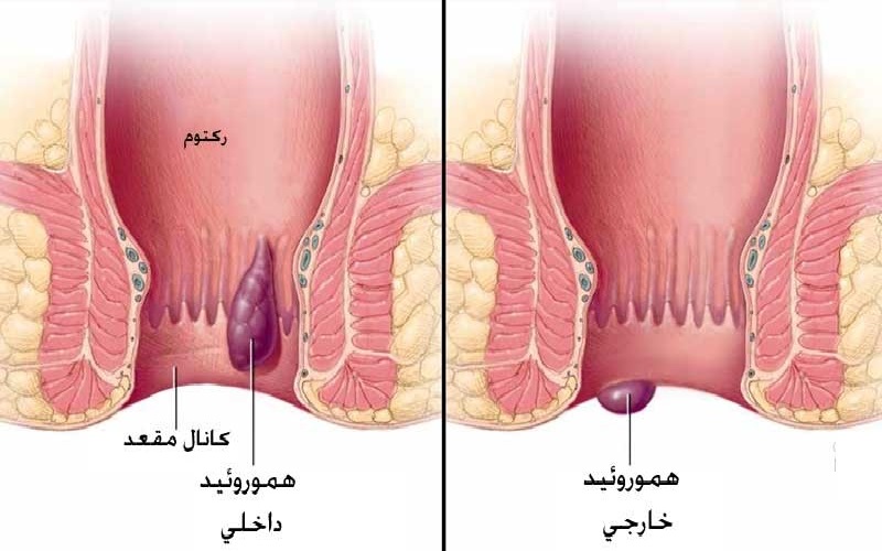 انواع بیماری های مقعدی و روش های پیشگیری از آنها 1 ۱. هموروئید (بواسیر)