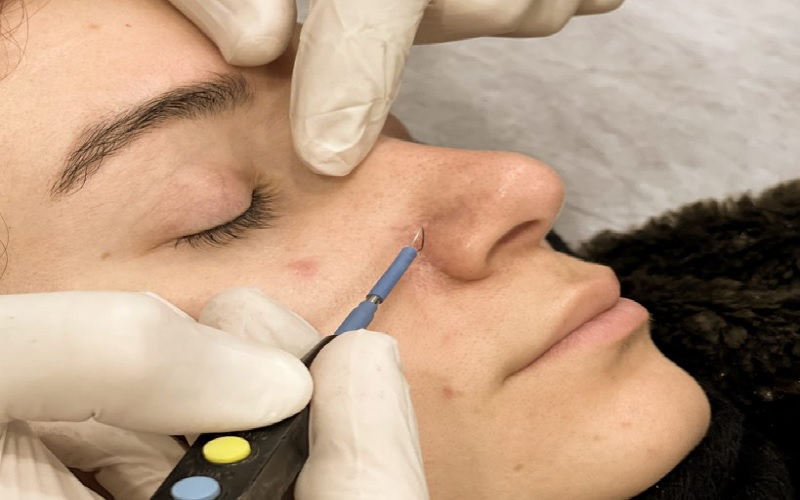 برداشتن خال صورت و بدن: 7 راهکار موثر، ایمن و بدون دردسر 1 برداشتن خال صورت و بدن