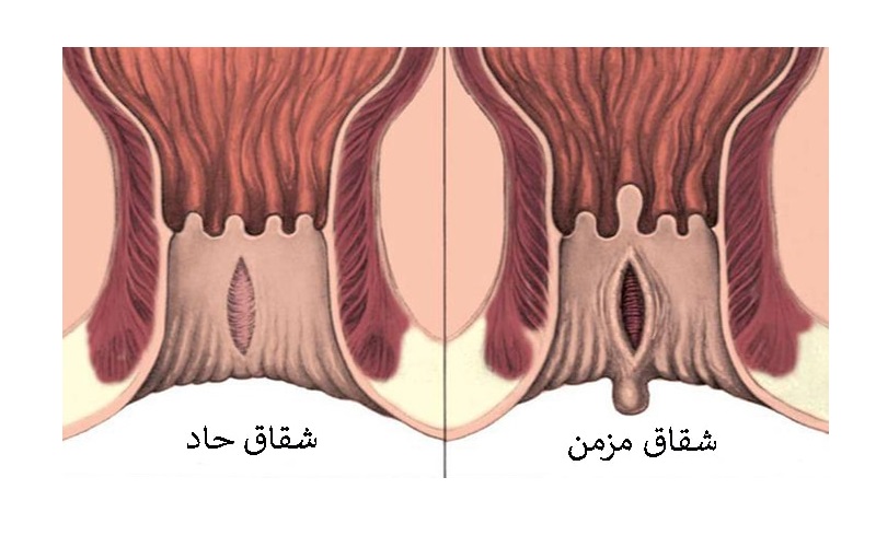 انواع بیماری های مقعدی و روش های پیشگیری از آنها 2 شقاق مقعدی (فیشر)