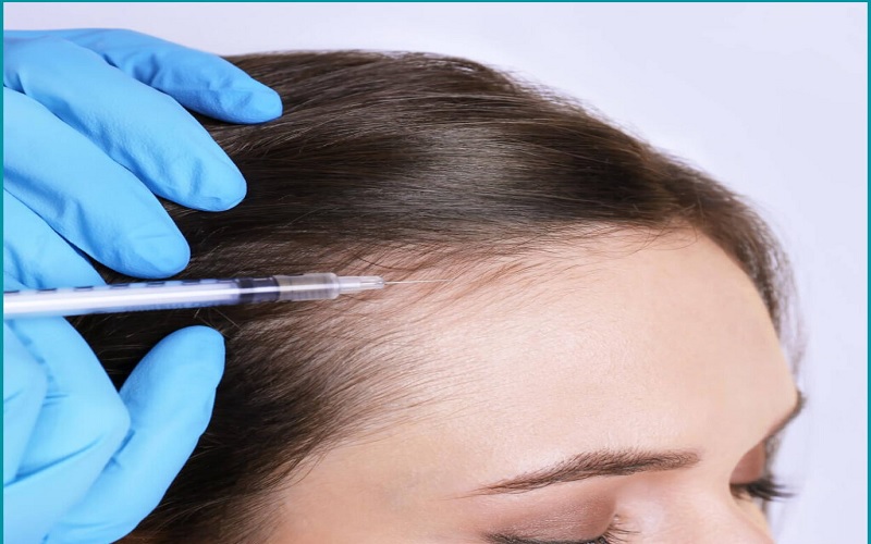سن مناسب مزوتراپی مو: ابهامات، واقعیتها و بهترین زمان برای درمان ریزش مو 1 سن مناسب مزوتراپی مو