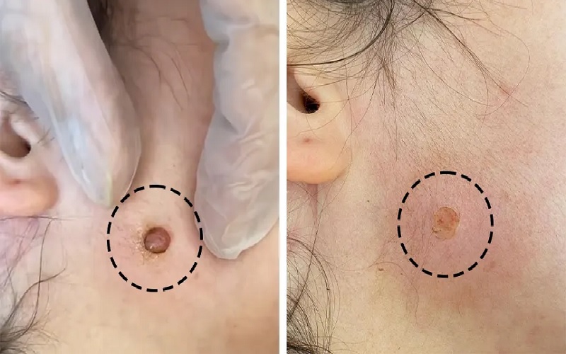 برداشتن خال صورت و بدن: 7 راهکار موثر، ایمن و بدون دردسر 2 ااا 3