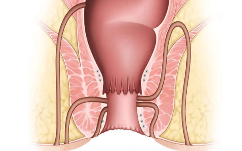 انواع بیماری های مقعدی و روش های پیشگیری از آنها 3 فیستول مقعدی