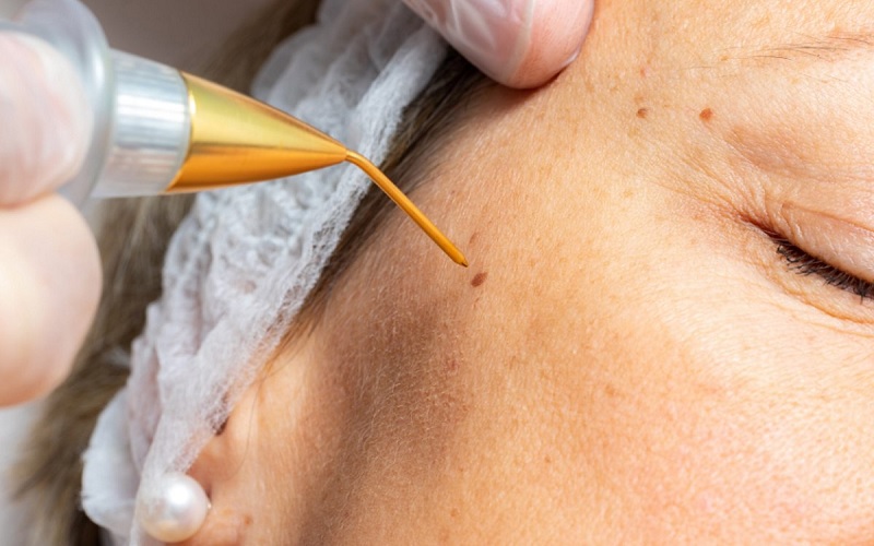 برداشتن خال صورت و بدن: 7 راهکار موثر، ایمن و بدون دردسر 3 اااا 5