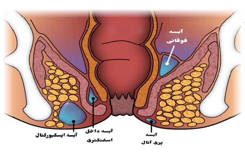 انواع بیماری های مقعدی و روش های پیشگیری از آنها 4 آبسه مقعدی