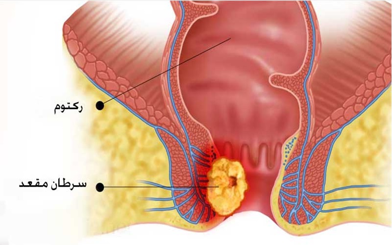 انواع بیماری های مقعدی و روش های پیشگیری از آنها 6 سرطان مقعد