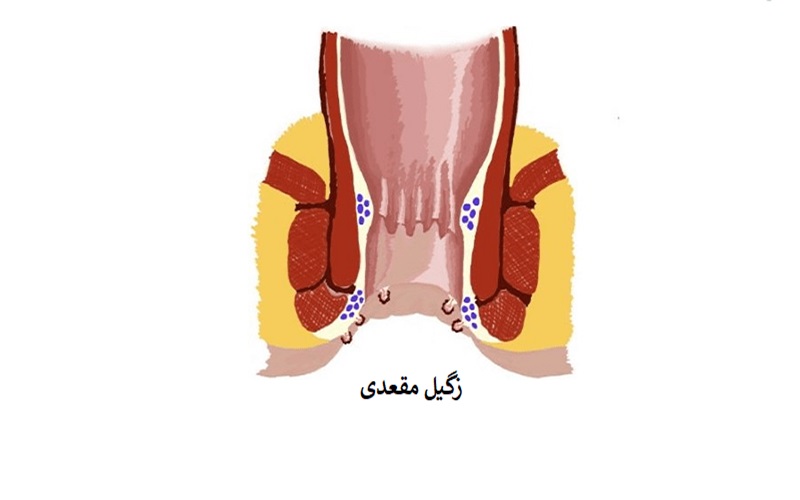 انواع بیماری های مقعدی و روش های پیشگیری از آنها 5 زگیل مقعدی