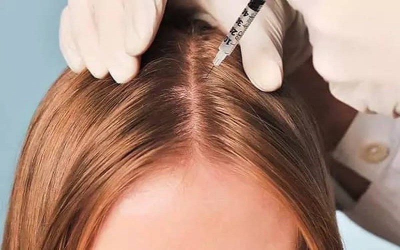 نحوه تزریق مزوتراپی مو: راهنمای جامع برای درک فرایند و نتایج 1 مزوتراپی مو چیست و چگونه به رشد مو کمک میکند؟