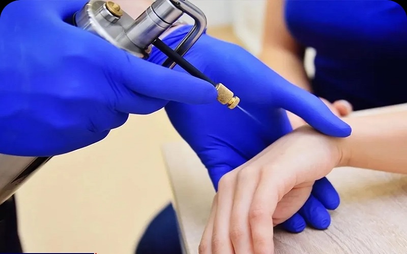 برداشتن خال صورت و بدن: 7 راهکار موثر، ایمن و بدون دردسر 5 کرایوتراپی (Cryotherapy): انجماد خال با نیتروژن مایع