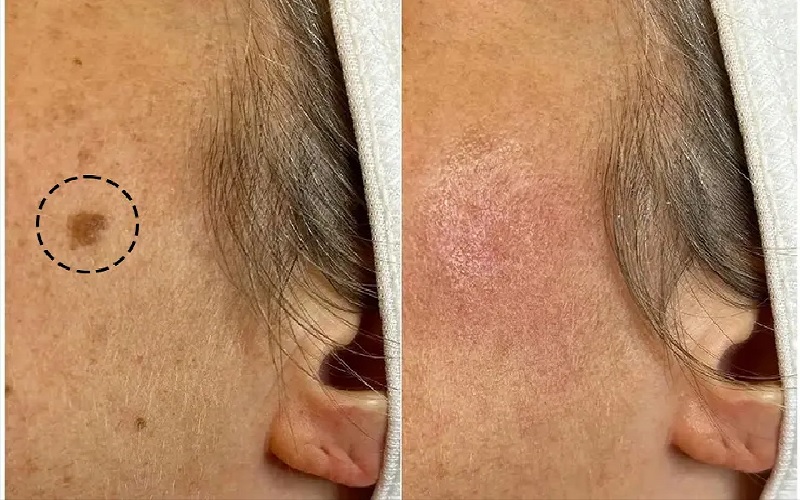برداشتن خال صورت و بدن: 7 راهکار موثر، ایمن و بدون دردسر 7 شیو اکسیشن (Shave Excision): روشی ساده برای خالهای برجسته