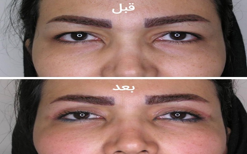 روشهای برداشتن پف بالای چشم بدون جراحی: راهنمای کامل از بین بردن پف پلک بدون عمل 3 مزایای برجسته روشهای برداشتن پف بالای چشم بدون جراحی