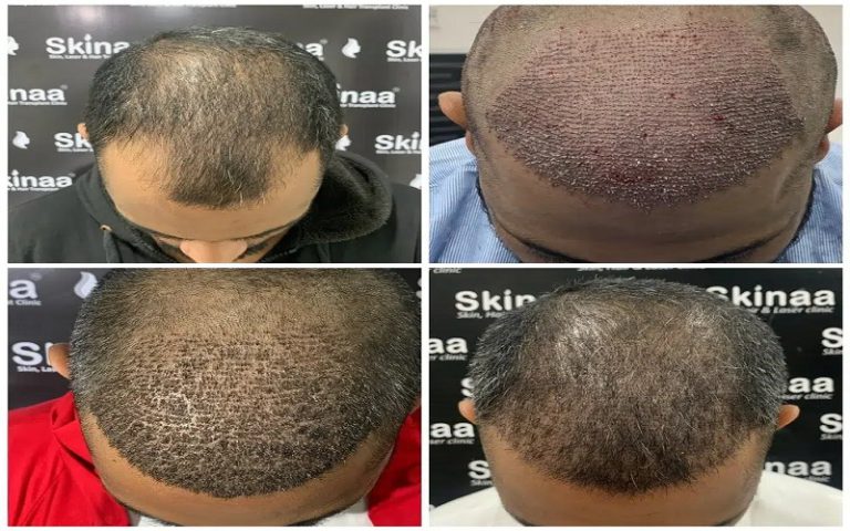 کاشت مو و مزوتراپی