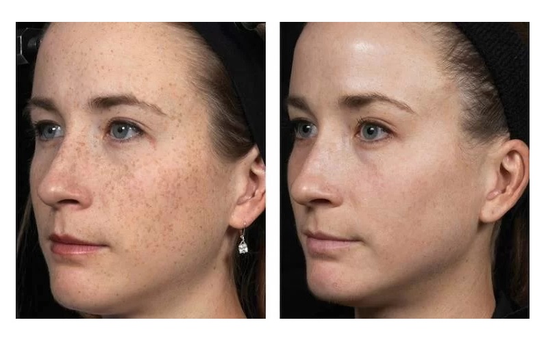 درمان کک و مک با 5 روش قطعی و موثر: راهنمای جامع آرامین کلینیک 1 کک و مک چیست و چرا روی پوست ظاهر میشود؟