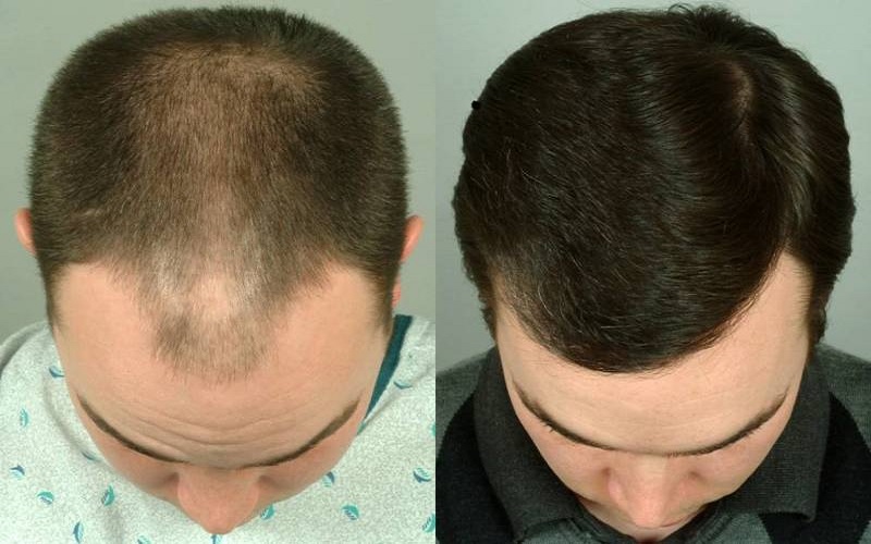 مقایسه کاشت مو و مزوتراپی: کدام روش برای شما بهتر است؟ 1 کاشت مو و مزوتراپی