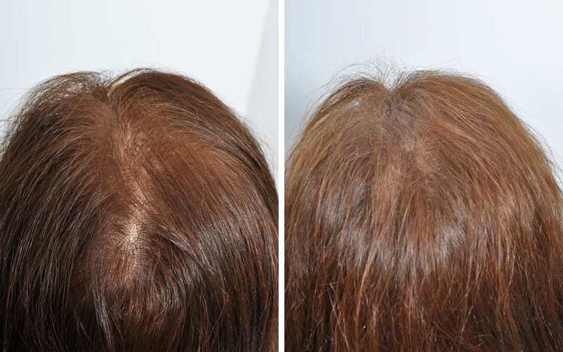 مقایسه کاشت مو و مزوتراپی: کدام روش برای شما بهتر است؟ 4 آمادگیهای لازم قبل از کاشت مو و مزوتراپی