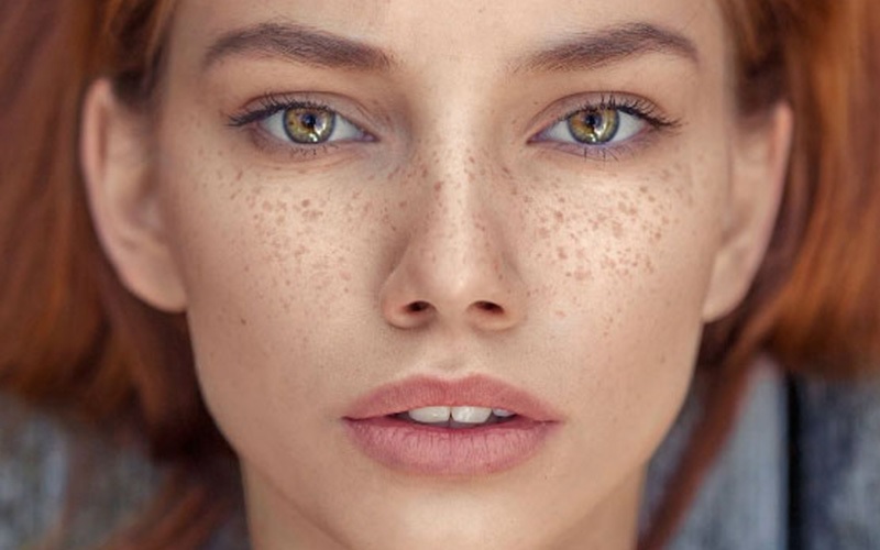 درمان کک و مک با 5 روش قطعی و موثر: راهنمای جامع آرامین کلینیک 3 درمان کک و مک با لیزر کیوسوئیچ: دقیق و هدفمند