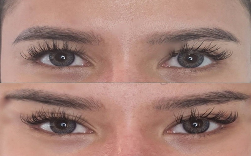 جراحی چشم روباهی چیست و چگونه انجام می شود؟ راهنمای کامل 1 جراحی چشم روباهی چیست؟ تعریفی جامع