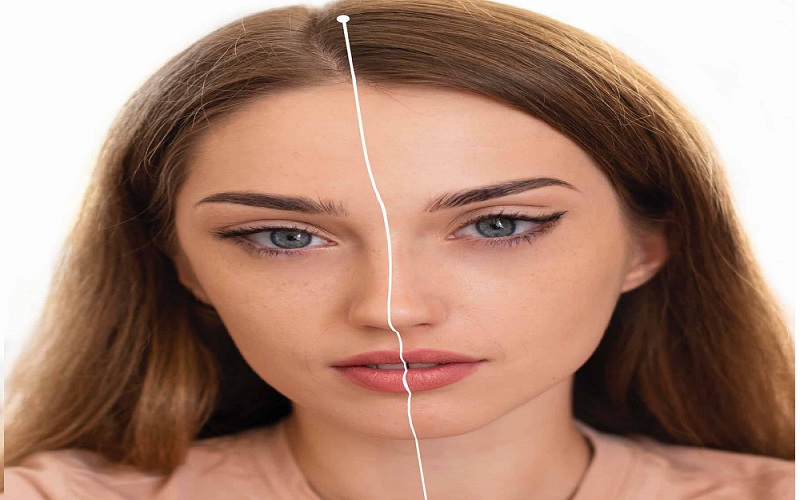 جراحی چشم روباهی چیست و چگونه انجام می شود؟ راهنمای کامل 2 جراحی چشم روباهی چگونه انجام می شود؟ مراحل گام به گام