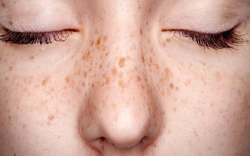 آشنایی کامل با انواع لک صورت، علل و بهترین راههای درمان و پیشگیری 2 لک آفتاب (Solar Lentigines): آثار نور خورشید