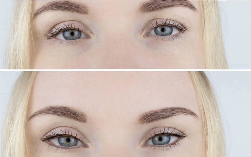 جراحی چشم روباهی چیست و چگونه انجام می شود؟ راهنمای کامل 3 مراقبت های قبل و بعد از جراحی چشم روباهی