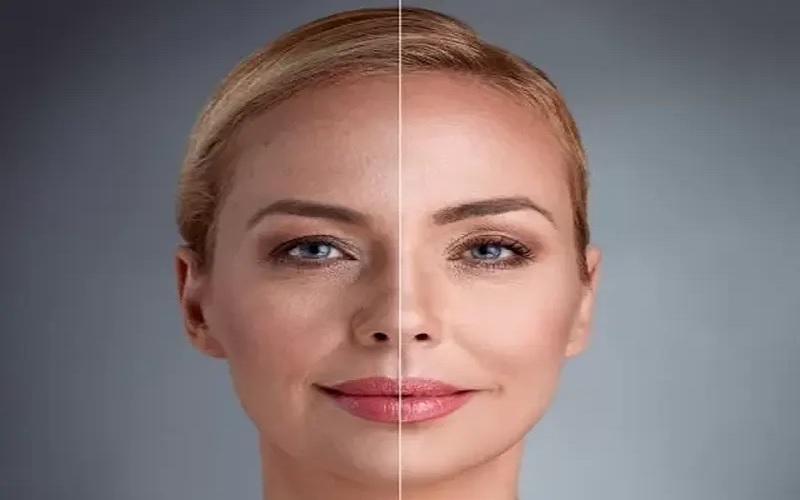 اندولیفت یا هایفو؛ انتخاب بهترین روش جوانسازی و لیفت صورت 1 اندولیفت