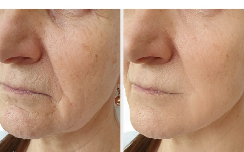 اندولیفت یا هایفو؛ انتخاب بهترین روش جوانسازی و لیفت صورت 4 اندولیفت بهتر است یا هایفو