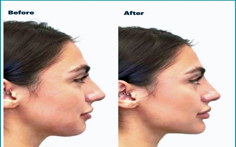 لیزر اندولیفت یا تزریق فیلر؟ مقایسه جامع و انتخاب بهترین روش جوانسازی 4 نکات مراقبتی ضروری پس از اندولیفت و تزریق فیلر