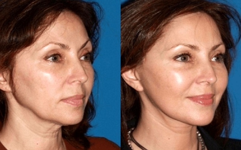 ژل لب بعد چند روز طبیعی میشه؟ راهنمای کامل برای داشتن لبهایی زیبا و طبیعی 4 چرا ژل لب زود جذب میشود؟ عوامل موثر بر ماندگاری