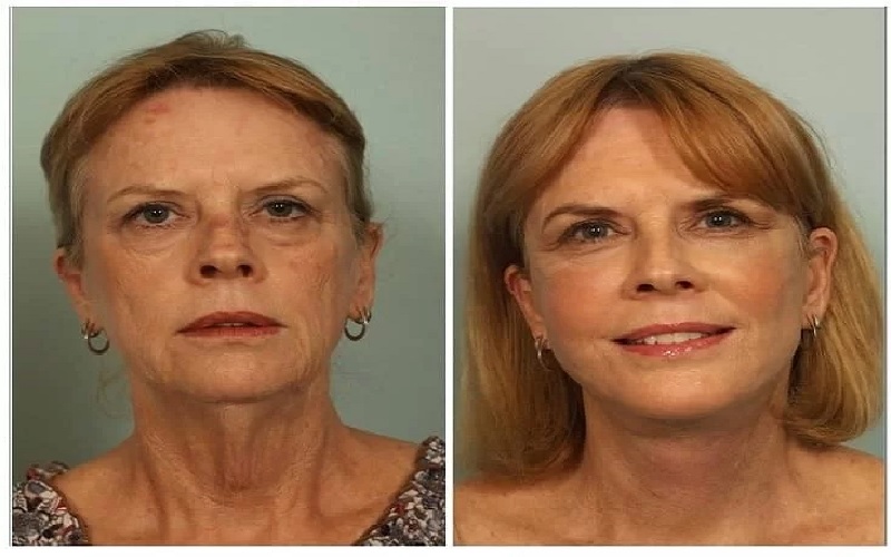 برای فرم دهی تزریق ژل یا چربی برای صورت بهتر است ؟ 4 تزریق ژل و چربی: تفاوتهای کلیدی و موارد منع مصرف