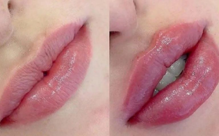 انواع تزریق ژل لب