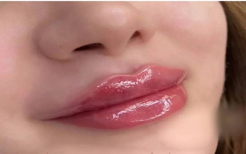 انواع تزریق ژل لب، مزایا، عوارض و انتخاب بهترین مدل 1 مدل نچرال (Natural Look)