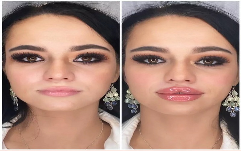 ژل لب بعد چند روز طبیعی میشه؟ راهنمای کامل برای داشتن لبهایی زیبا و طبیعی 2 ورم ژل لب: چه مدت طول میکشد و چگونه آن را کنترل کنیم؟