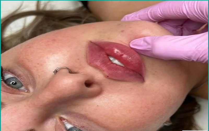 انواع تزریق ژل لب، مزایا، عوارض و انتخاب بهترین مدل 3 ففف