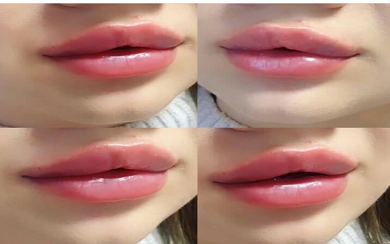 انواع تزریق ژل لب، مزایا، عوارض و انتخاب بهترین مدل 4 فففف